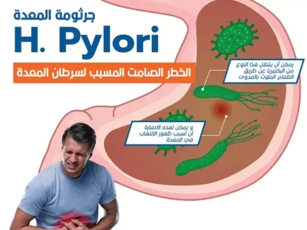 ما أعراض وأسباب جرثومة المعدة؟